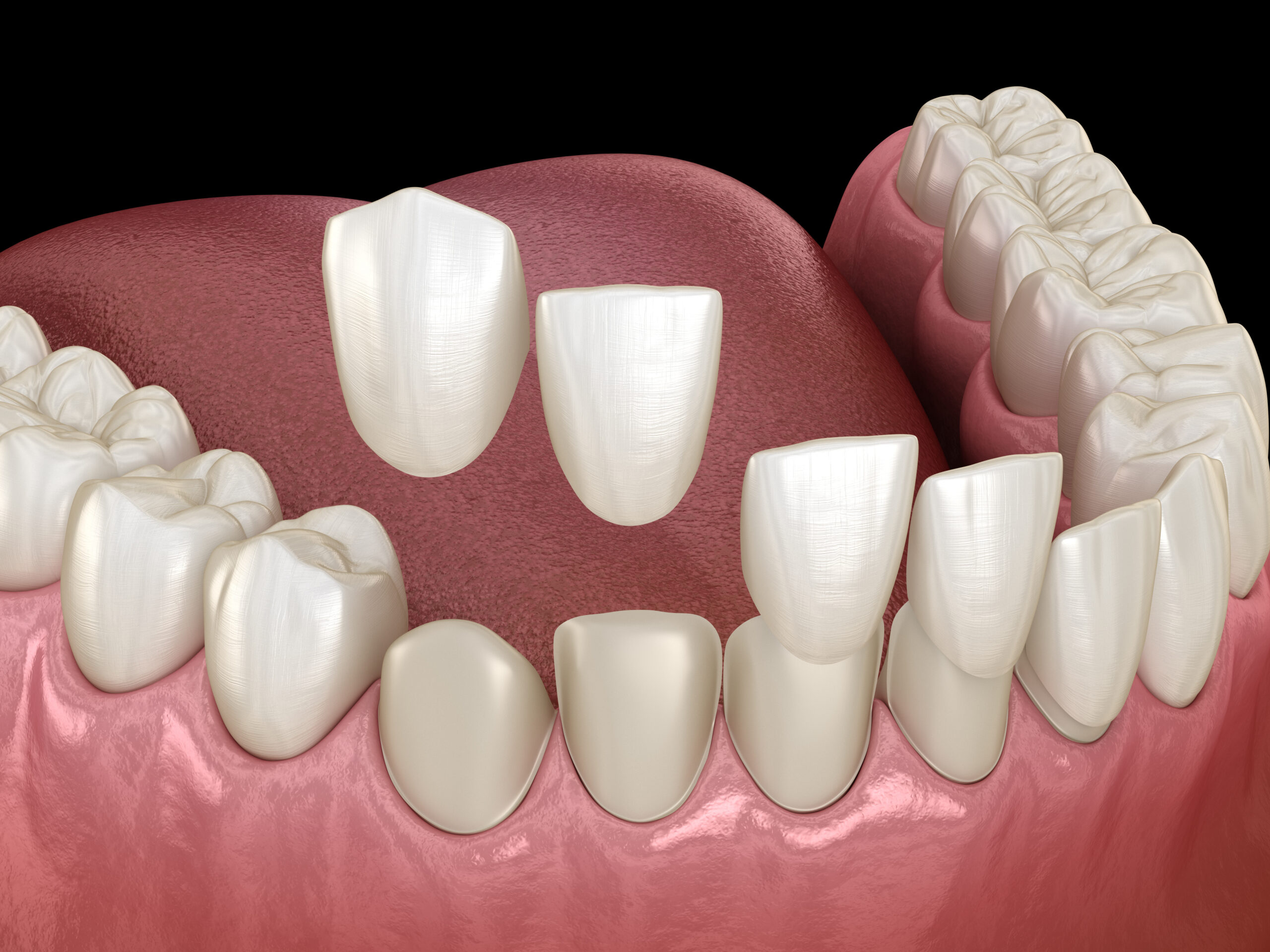 Full Mouth Rehabilitation